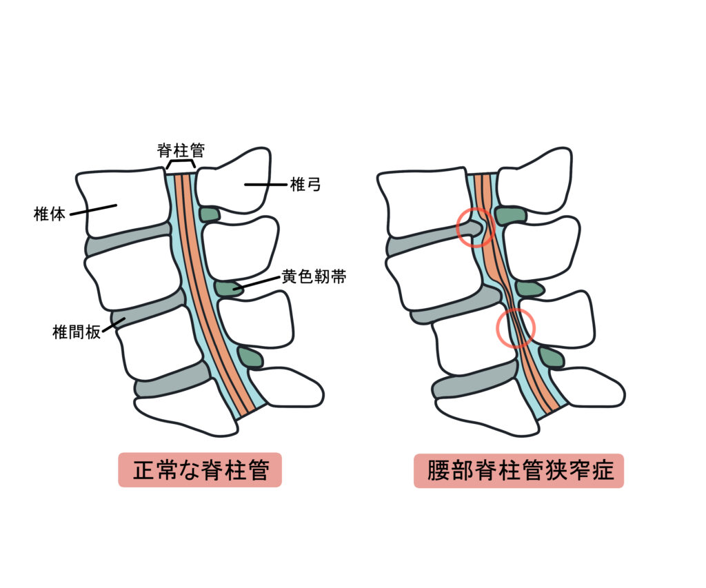 脊柱菅狭窄症