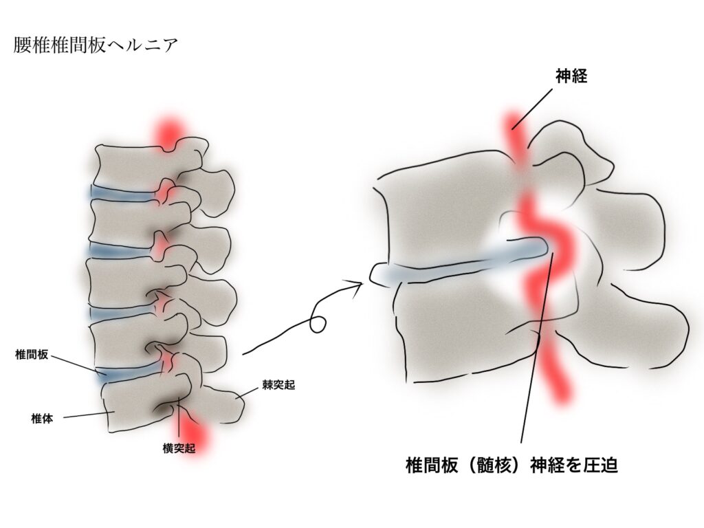 椎間板ヘルニア