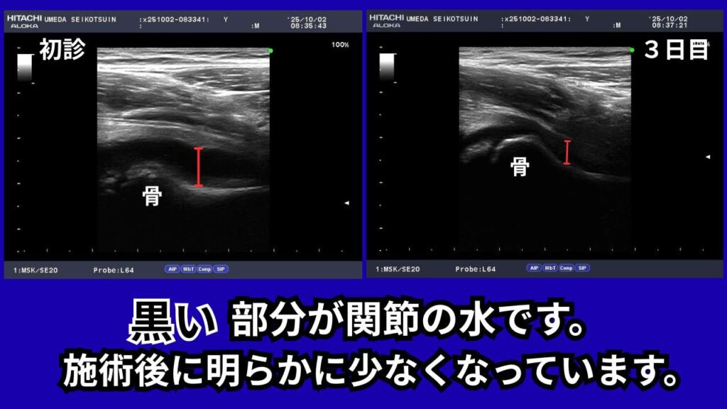 単純性股関節炎のエコー画像