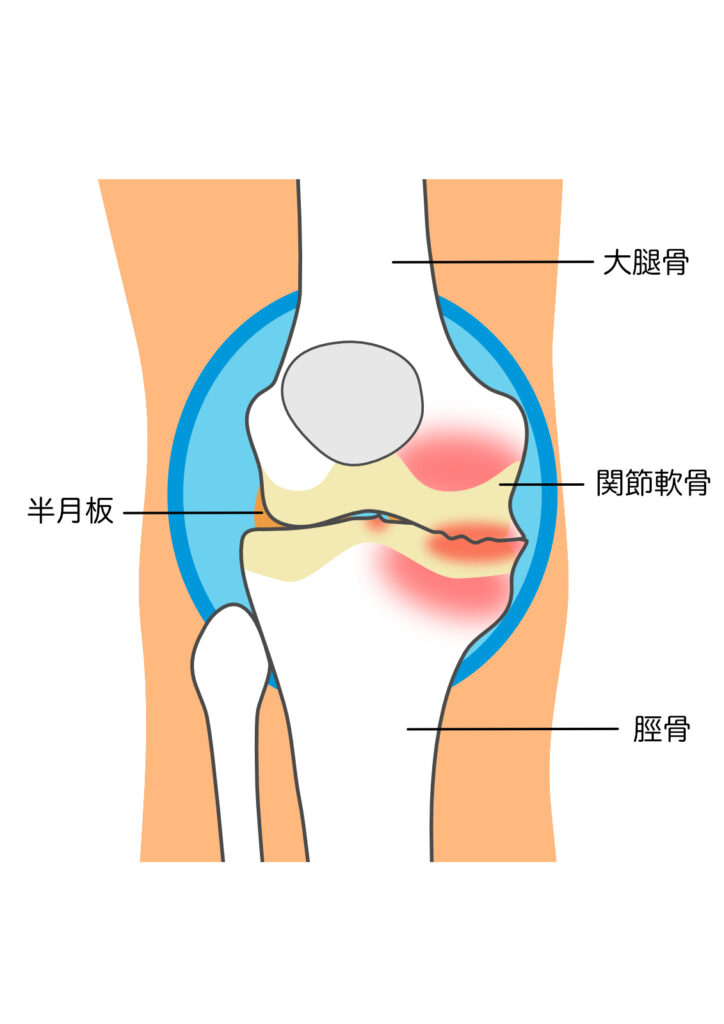 変形性膝関節症